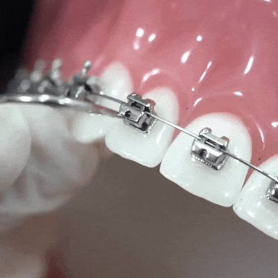 Brackets Autoligado