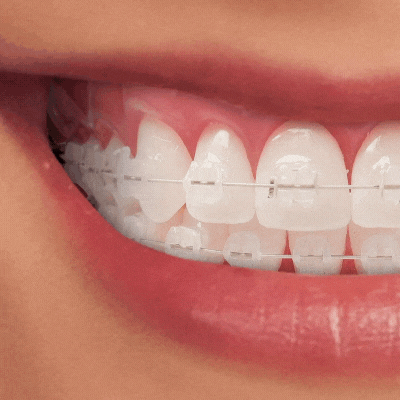 Brackets Estéticos